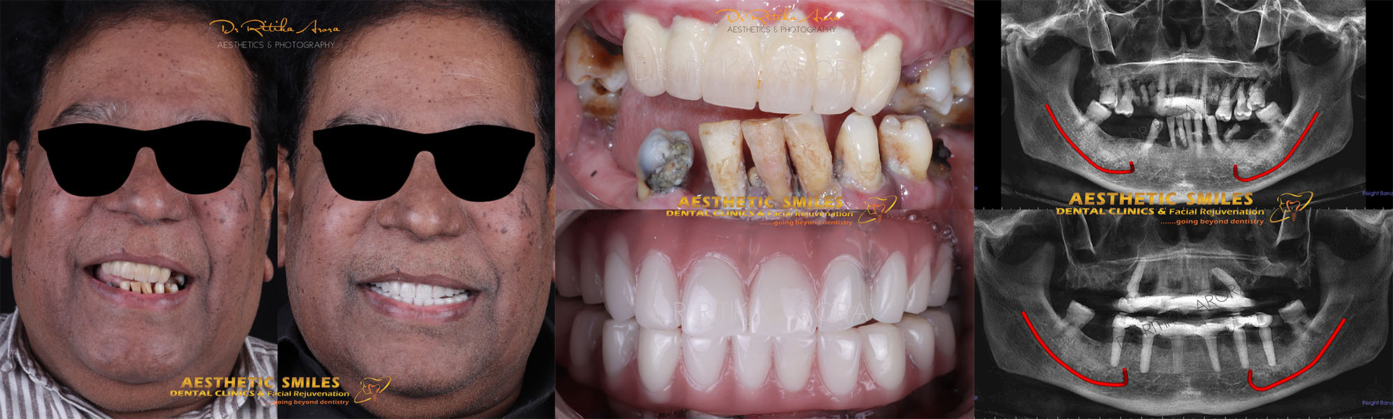 dental implants in mumbai case 2