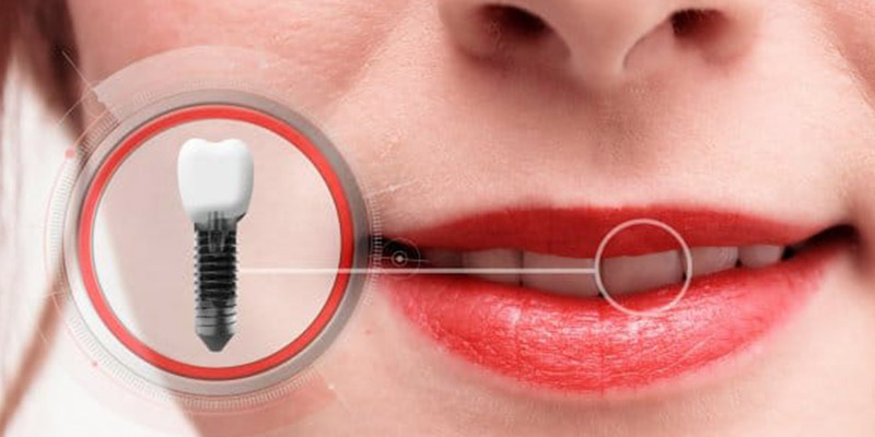 dental implants natural match