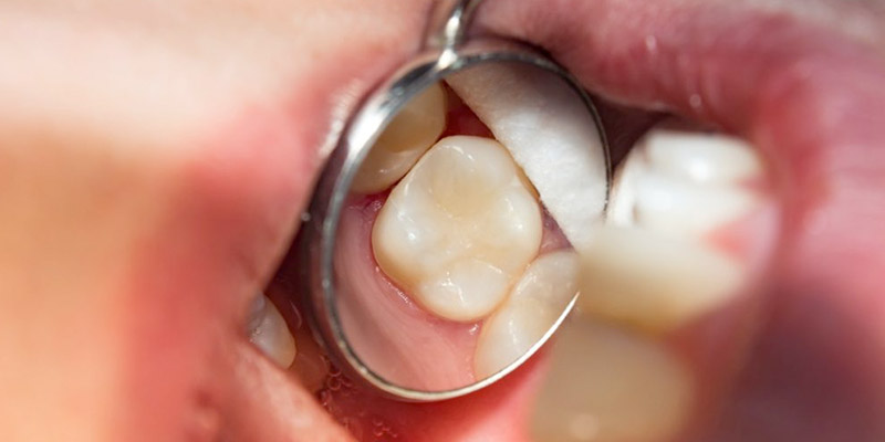 No more cavities and great maintenance