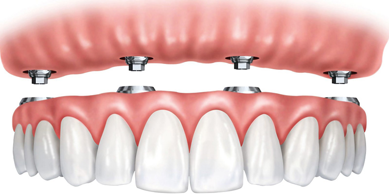 All On 4 Dental Implants