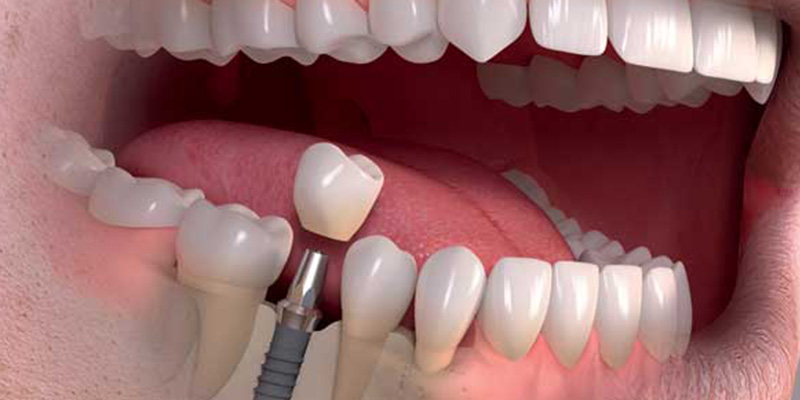 Immediate Dental Implants