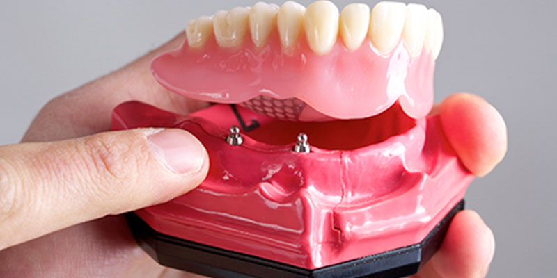 Implant Overdentures