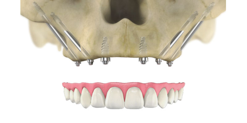  Zygomatic Implants
