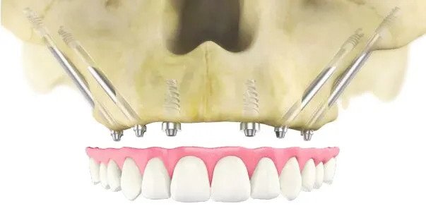 Zygomatic Implants