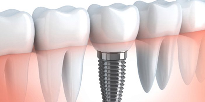 Dental Implants in Mumbai