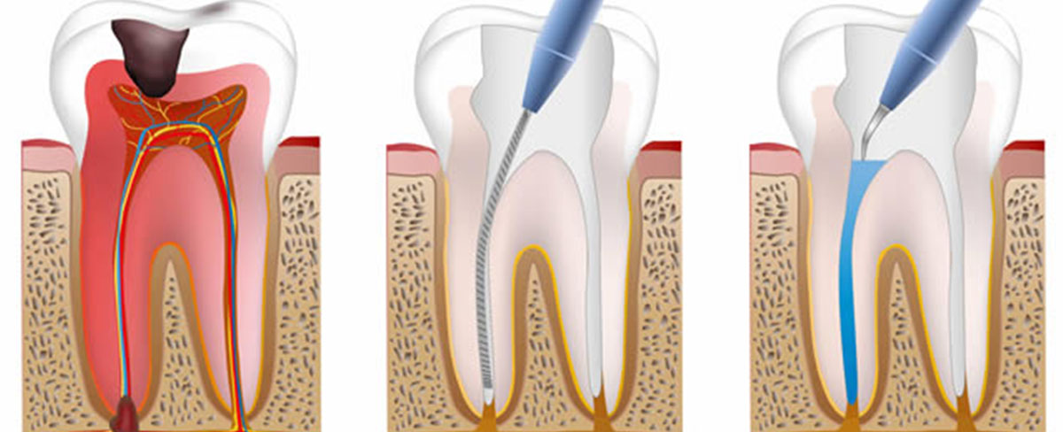 Before and After Care of Root Canal Treatment