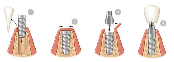 Dental implant process Mumbai