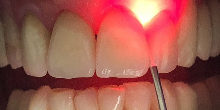 https://www.aestheticsmilesindia.com/wp-content/uploads/2021/02/dental-lasers.jpg