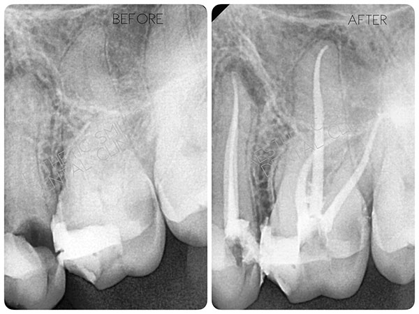 https://www.aestheticsmilesindia.com/wp-content/uploads/2021/03/Root-Canal-Treatment-before-after-case-4.jpg