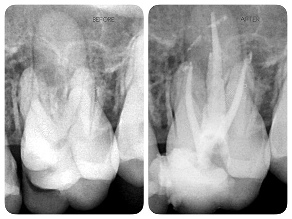 https://www.aestheticsmilesindia.com/wp-content/uploads/2021/03/Root-Canal-Treatment-before-after-case-7-1.jpg