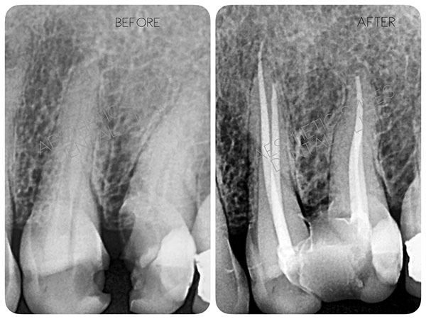 https://www.aestheticsmilesindia.com/wp-content/uploads/2021/03/Root-Canal-Treatment-before-after-case-8-1.jpg