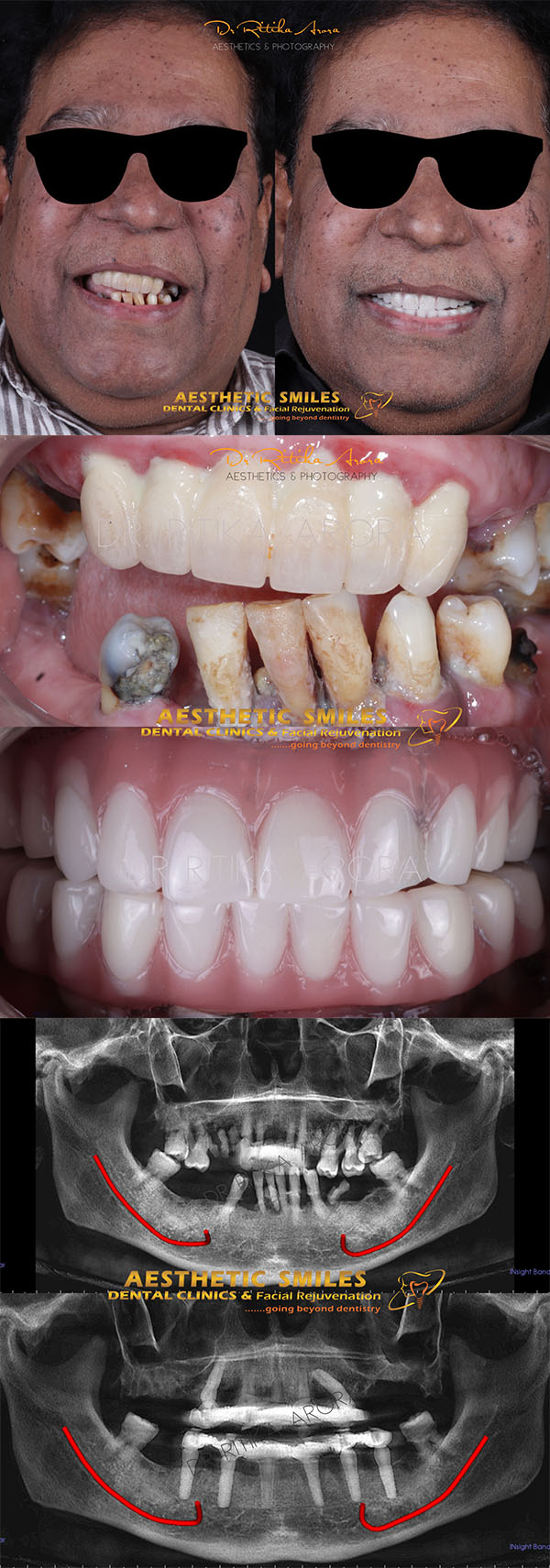 dental implants in mumbai case 2