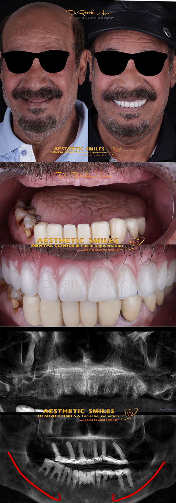 dental implants in mumbai case 3