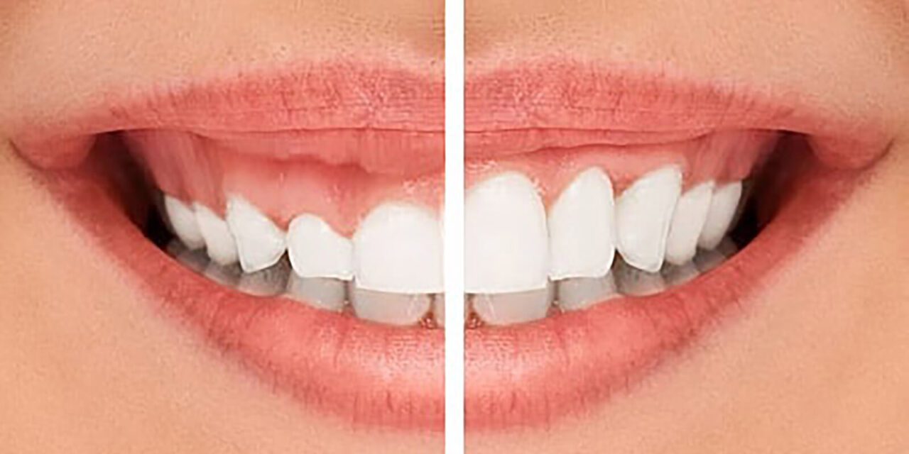 Gummy Smile Correction: Techniques and Procedures