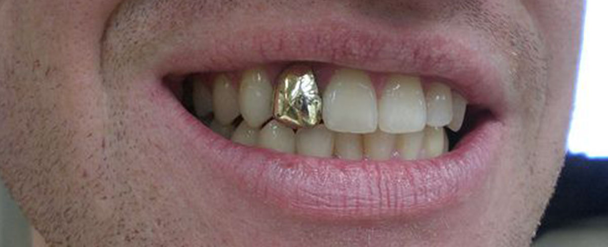 Gold Teeth Cap Price in India