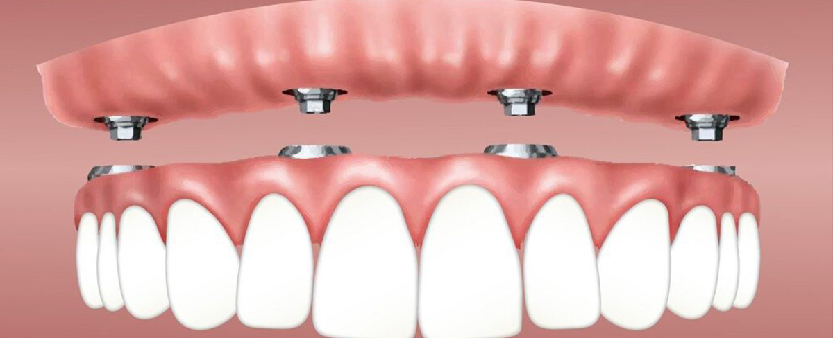 All-on-4 Dental Implants Cost in India