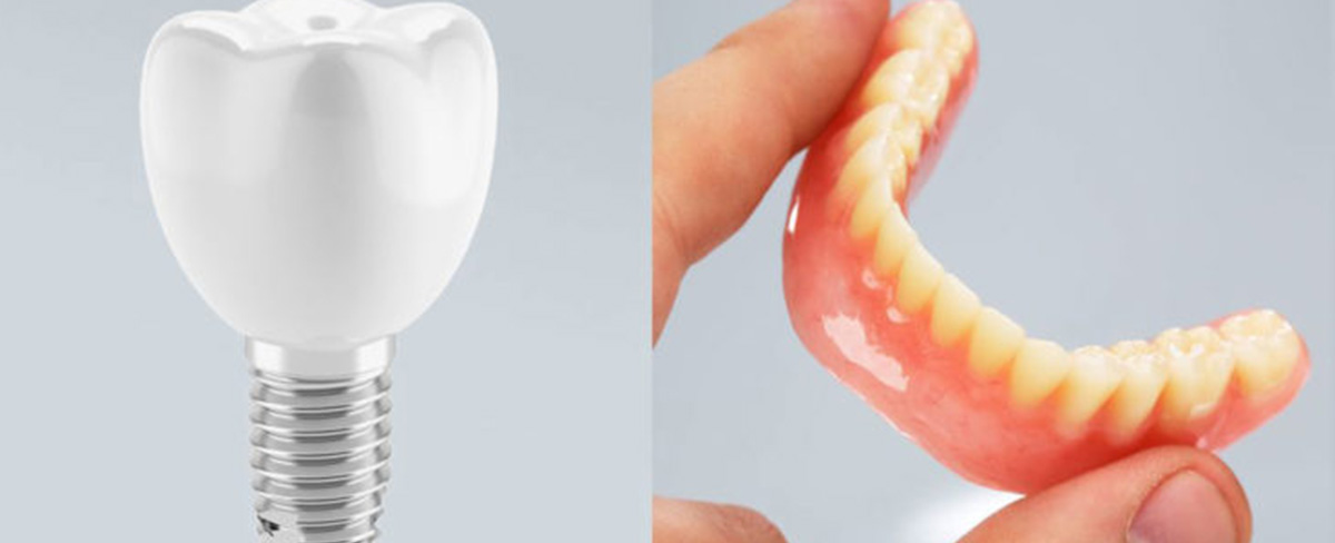 Dental Implants vs. Dentures: Which is Better in the Long Run?