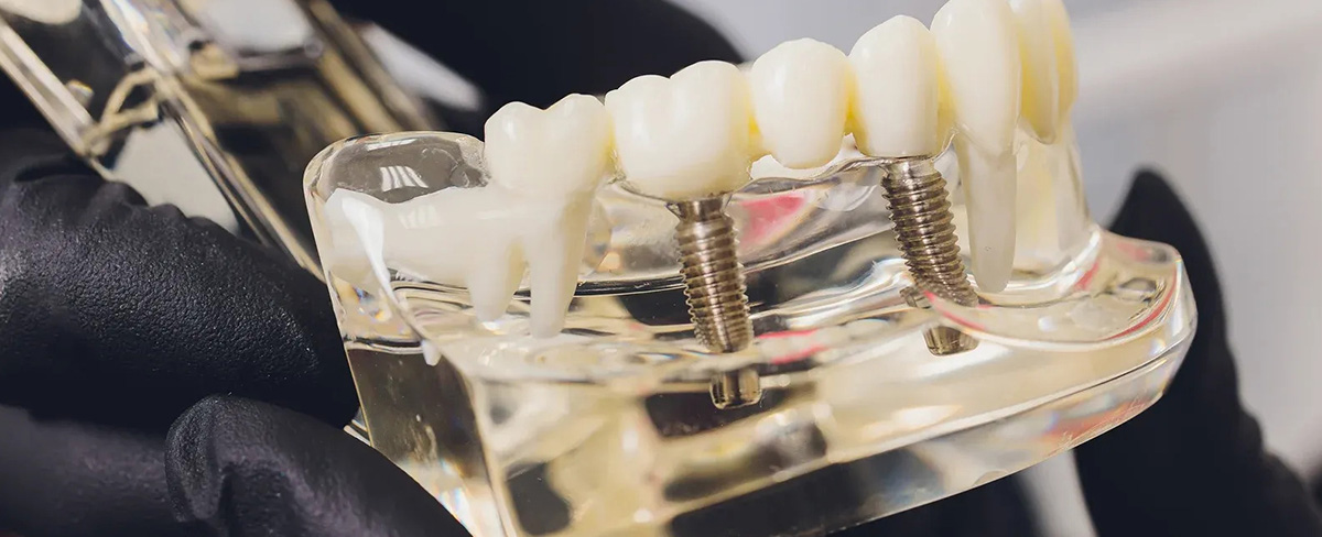 What is the Difference Between All-on-4 Implants and Traditional Implants?