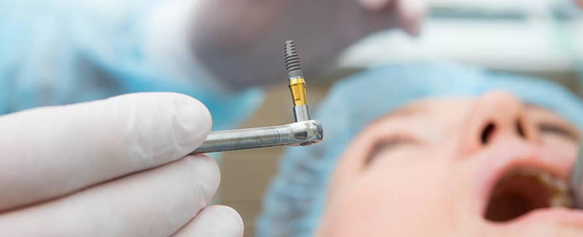 How Long Does It Take to Recover After Dental Implant Surgery?