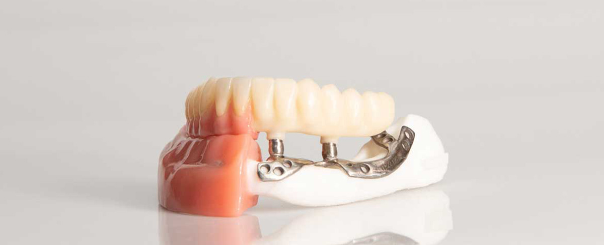 Endosteal vs. Subperiosteal Implants: Understanding the Difference