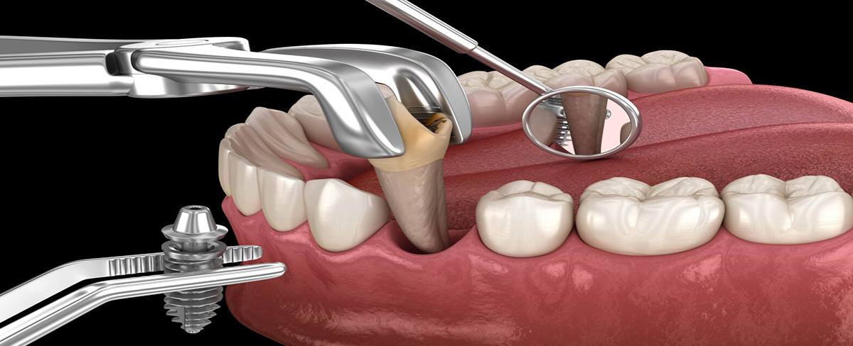 Can Dental Implants Be Done Immediately After Tooth Extraction?