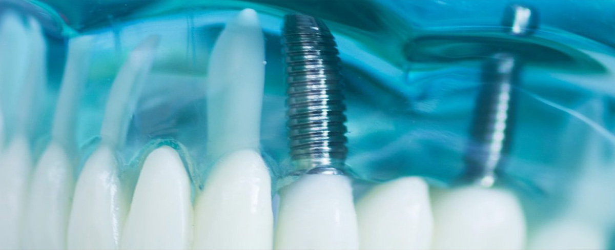 Mini Dental Implants in Mumbai, India