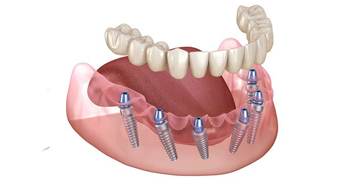 full mouth dental implants https://www.aestheticsmilesindia.com/wp-content/uploads/2026/06/full-mouth-dental-implants.jpg